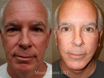 Facelift Before & After Gallery - Patient 320280 - Image 1