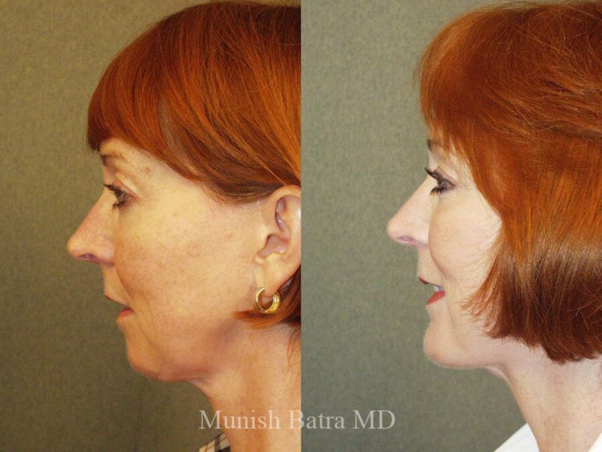 Rhinoplasty Before & After Gallery - Patient 302903 - Image 1