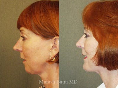 Rhinoplasty Before & After Gallery - Patient 302903 - Image 1