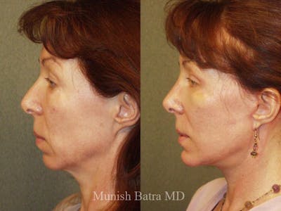 Rhinoplasty Before & After Gallery - Patient 335550 - Image 1