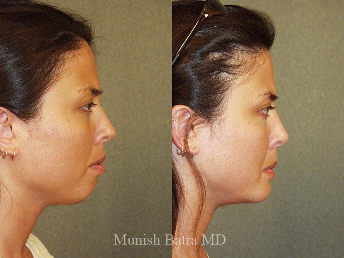 Rhinoplasty Before & After Gallery - Patient 429504 - Image 1
