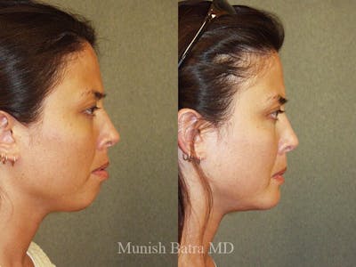 Rhinoplasty Before & After Gallery - Patient 429504 - Image 1