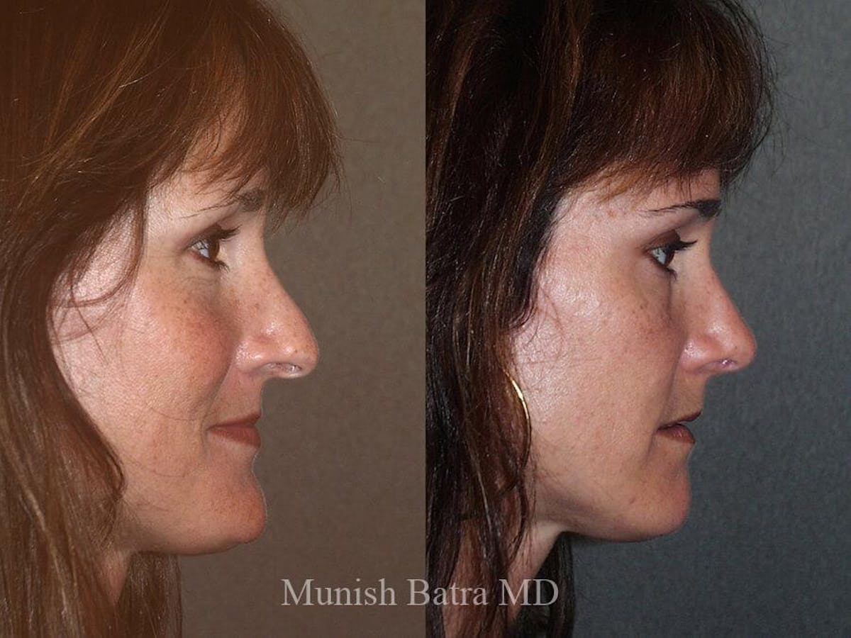Rhinoplasty Before & After Gallery - Patient 143370 - Image 1
