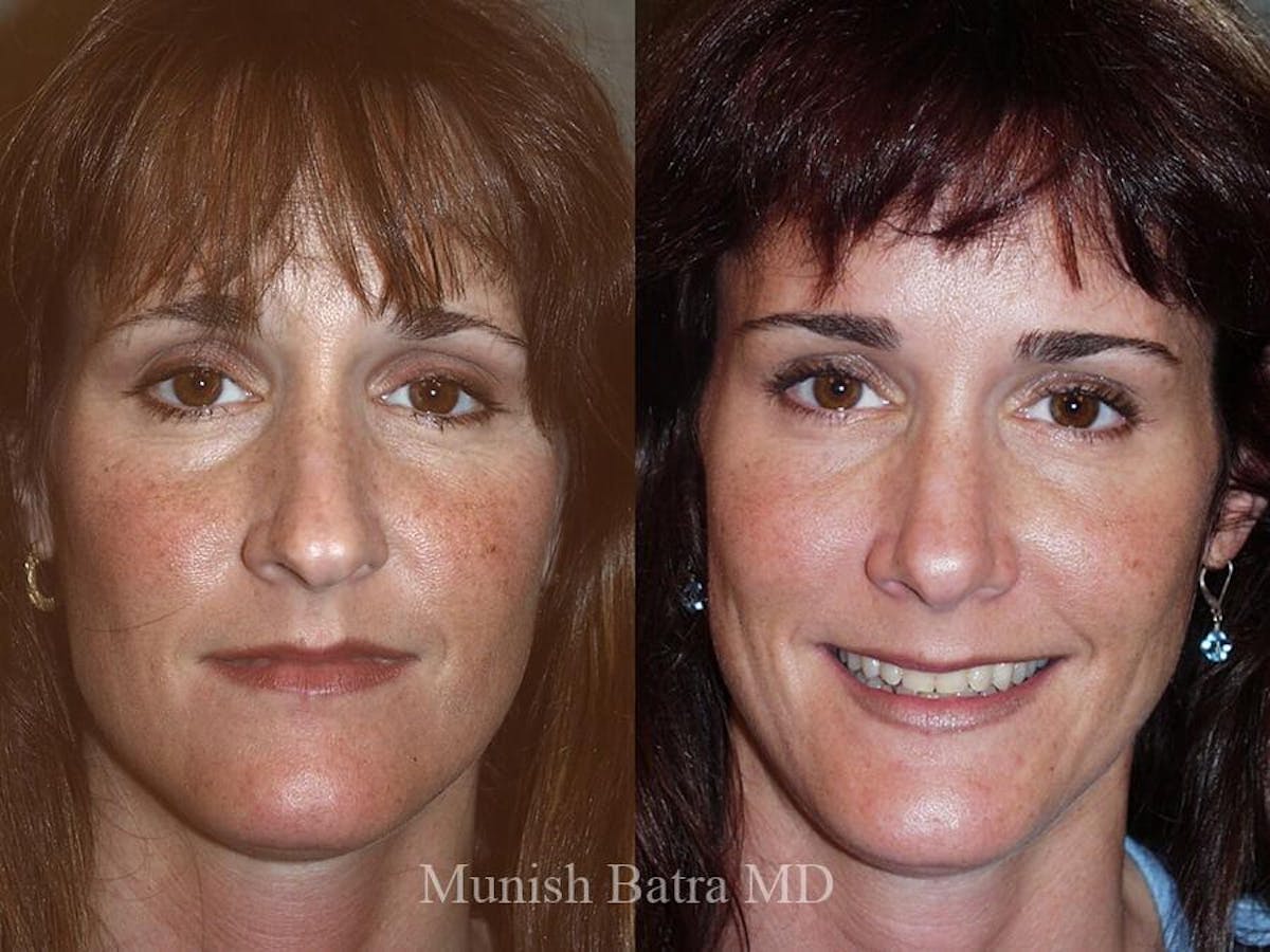 Rhinoplasty Before & After Gallery - Patient 143370 - Image 2