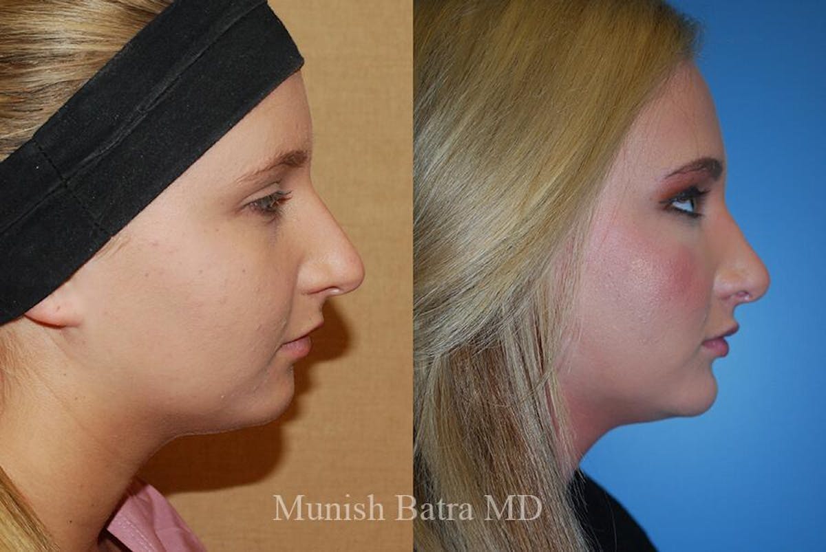 Rhinoplasty Before & After Gallery - Patient 214619 - Image 1