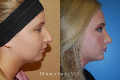 Rhinoplasty Before & After Gallery - Patient 214619 - Image 1