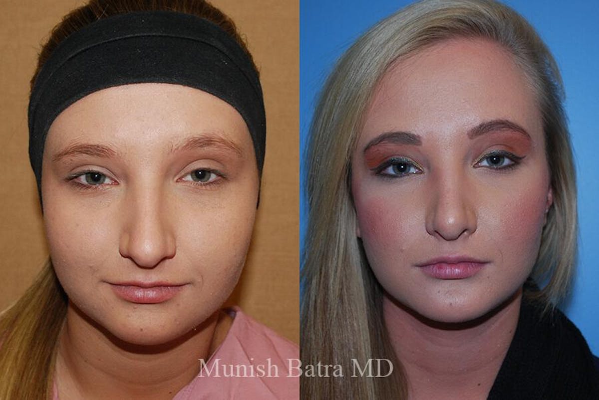 Rhinoplasty Before & After Gallery - Patient 214619 - Image 2
