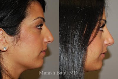 Rhinoplasty Before & After Gallery - Patient 118928 - Image 1