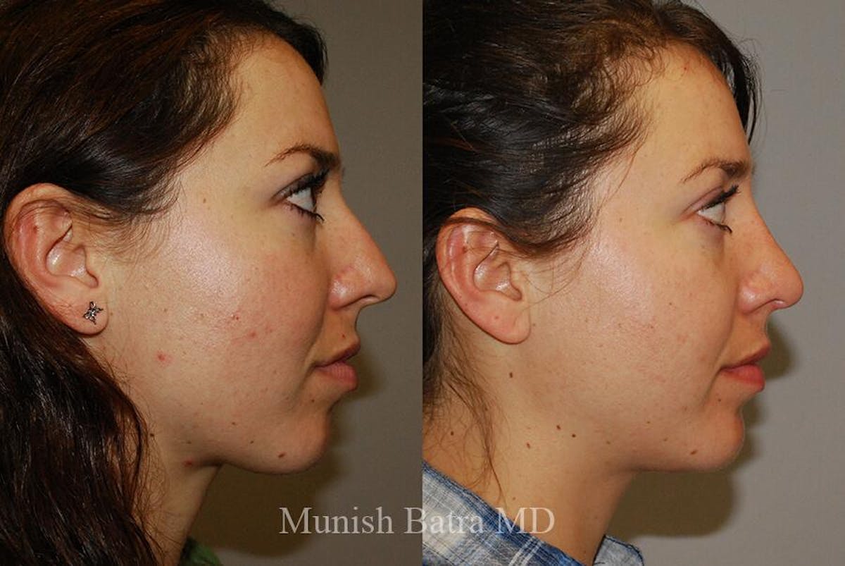 Rhinoplasty Before & After Gallery - Patient 103328 - Image 1