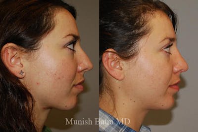 Rhinoplasty Before & After Gallery - Patient 103328 - Image 1