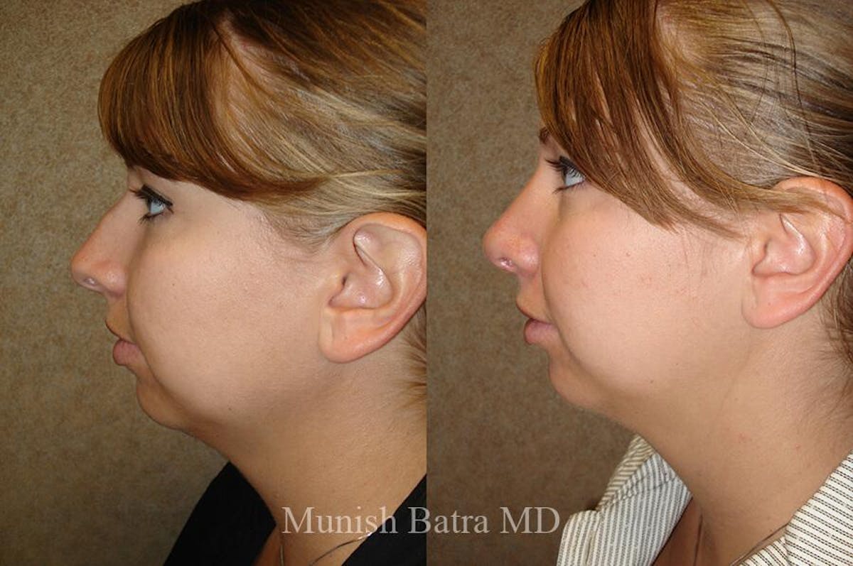 Rhinoplasty Before & After Gallery - Patient 335316 - Image 1