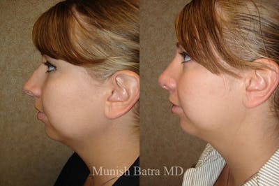 Rhinoplasty Before & After Gallery - Patient 335316 - Image 1