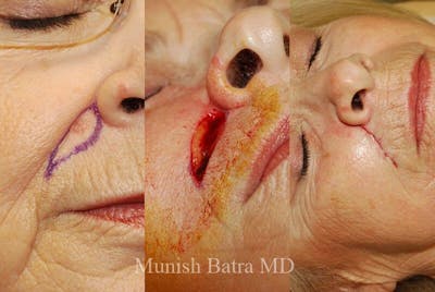 Skin Cancer Before & After Gallery - Patient 373662 - Image 1