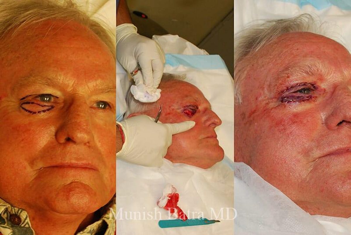 Skin Cancer Before & After Gallery - Patient 367589 - Image 1