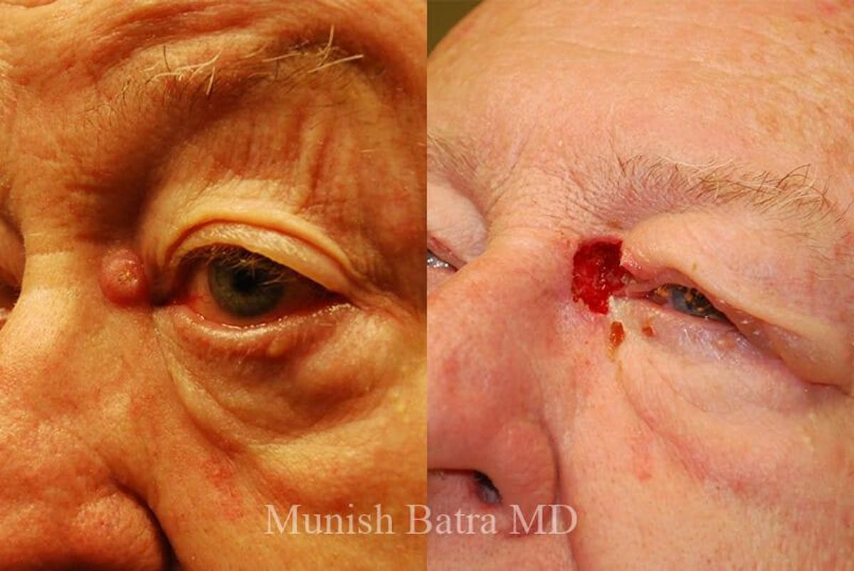 Skin Cancer Before & After Gallery - Patient 205363 - Image 1