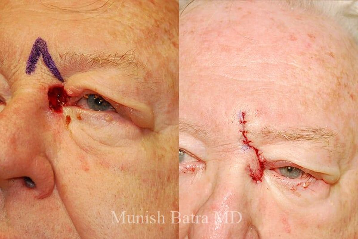 Skin Cancer Before & After Gallery - Patient 205363 - Image 2