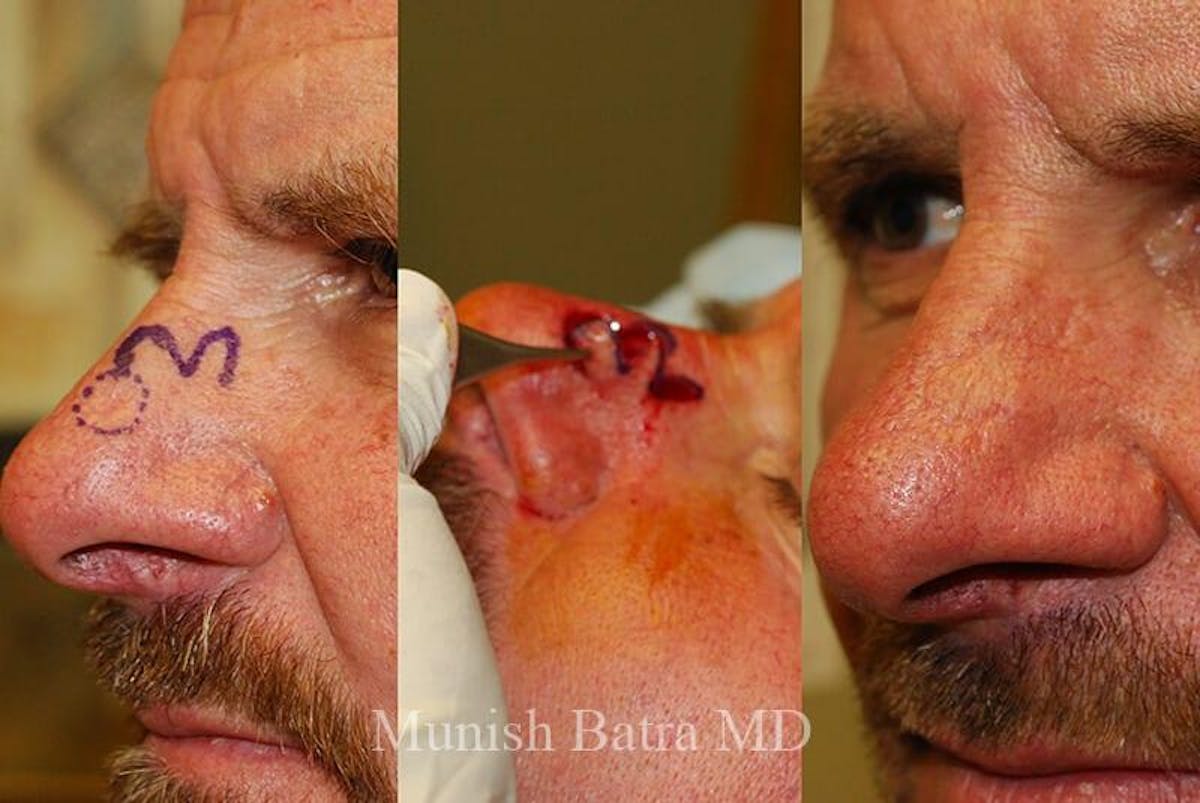 Skin Cancer Before & After Gallery - Patient 372247 - Image 1
