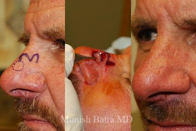 Skin Cancer Before & After Gallery - Patient 372247 - Image 1