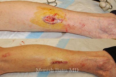 Skin Cancer Before & After Gallery - Patient 115428 - Image 1