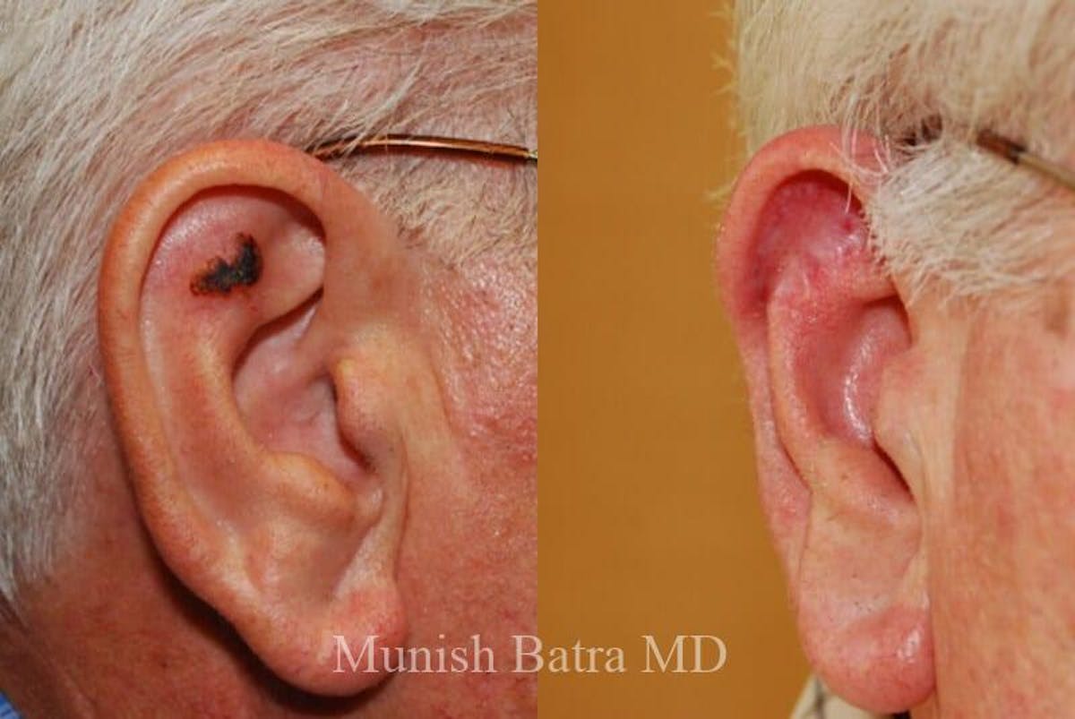 Skin Cancer Before & After Gallery - Patient 451410 - Image 1