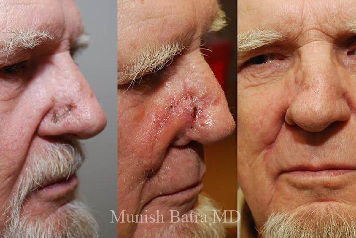 Skin Cancer Before & After Gallery - Patient 131230 - Image 1