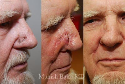 Skin Cancer Before & After Gallery - Patient 131230 - Image 1