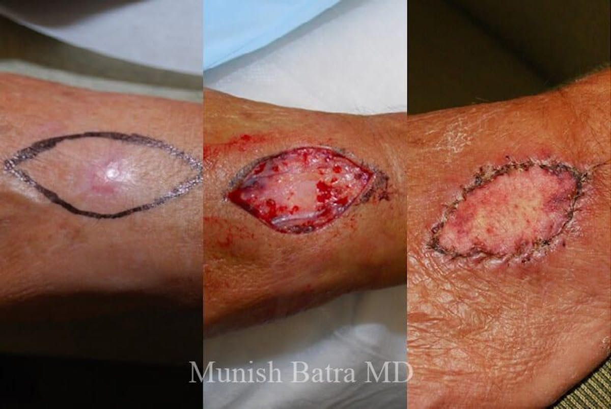 Skin Cancer Before & After Gallery - Patient 405474 - Image 1