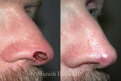 Skin Cancer Before & After Gallery - Patient 188964 - Image 1