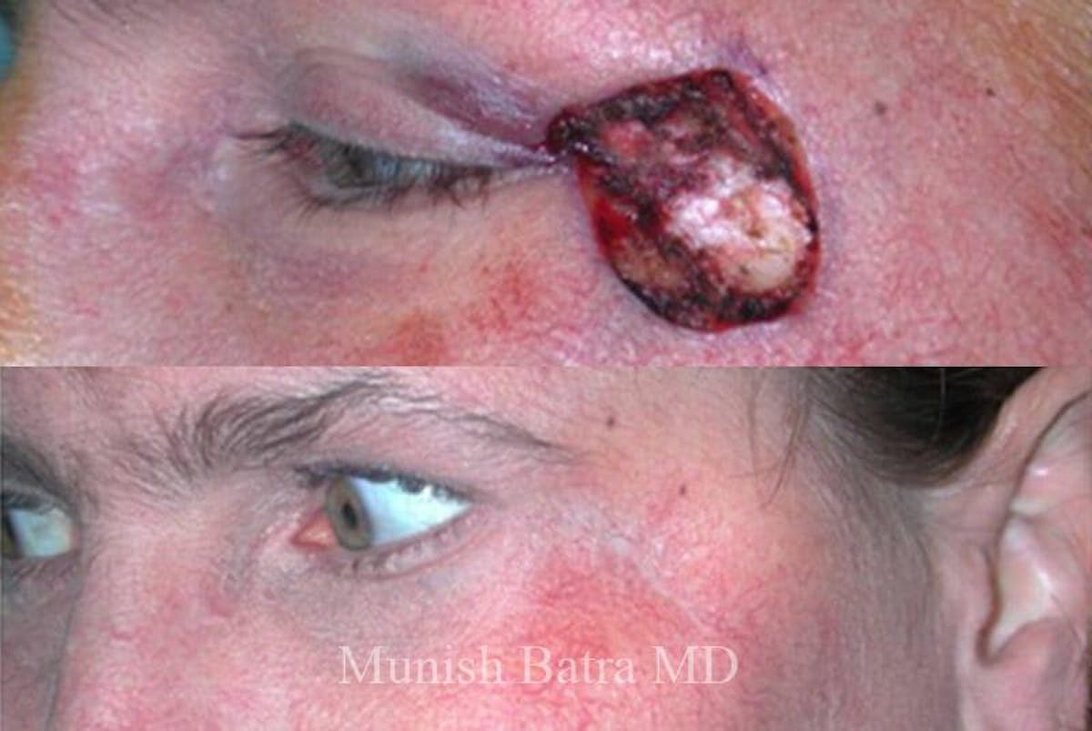 Skin Cancer Before & After Gallery - Patient 332816 - Image 1