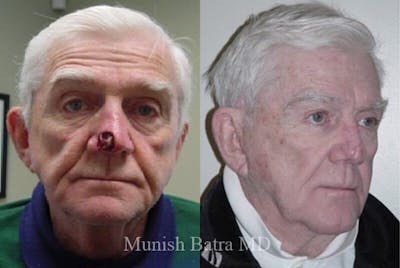 Skin Cancer Before & After Gallery - Patient 381646 - Image 1