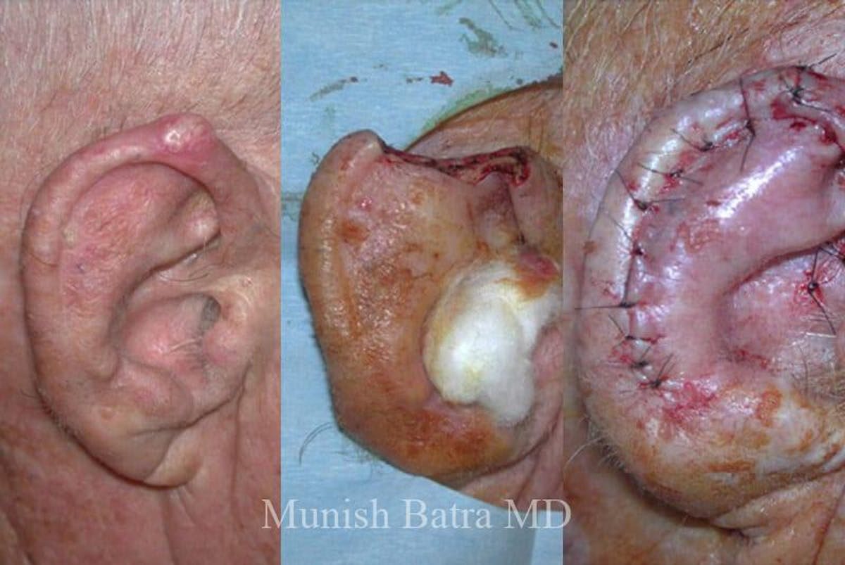 Skin Cancer Before & After Gallery - Patient 344778 - Image 1