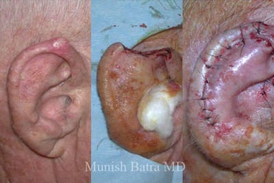 Skin Cancer Before & After Gallery - Patient 344778 - Image 1