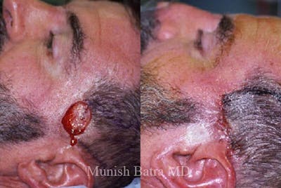 Skin Cancer Before & After Gallery - Patient 202197 - Image 1