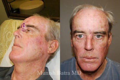 Skin Cancer Before & After Gallery - Patient 178155 - Image 1