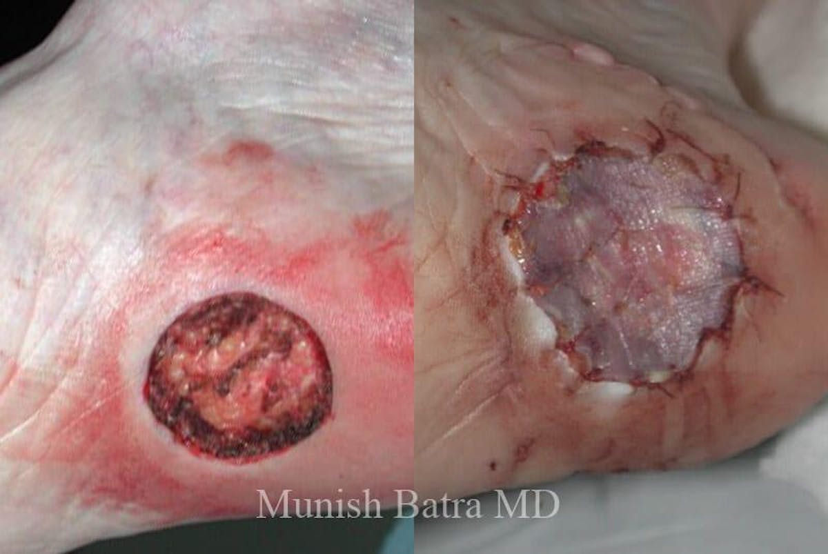 Skin Cancer Before & After Gallery - Patient 329011 - Image 1