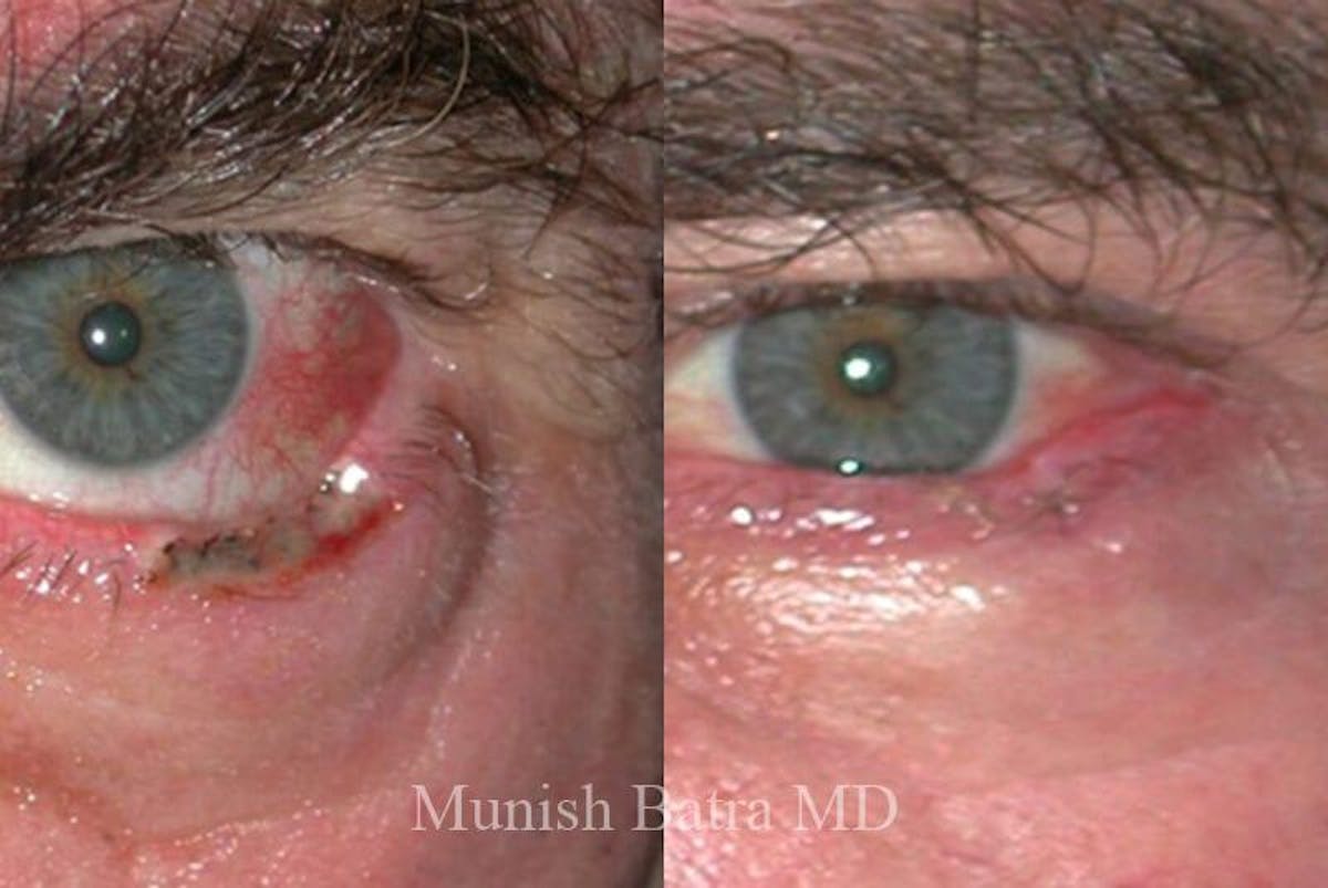 Skin Cancer Before & After Gallery - Patient 293474 - Image 1