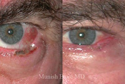 Skin Cancer Before & After Gallery - Patient 293474 - Image 1