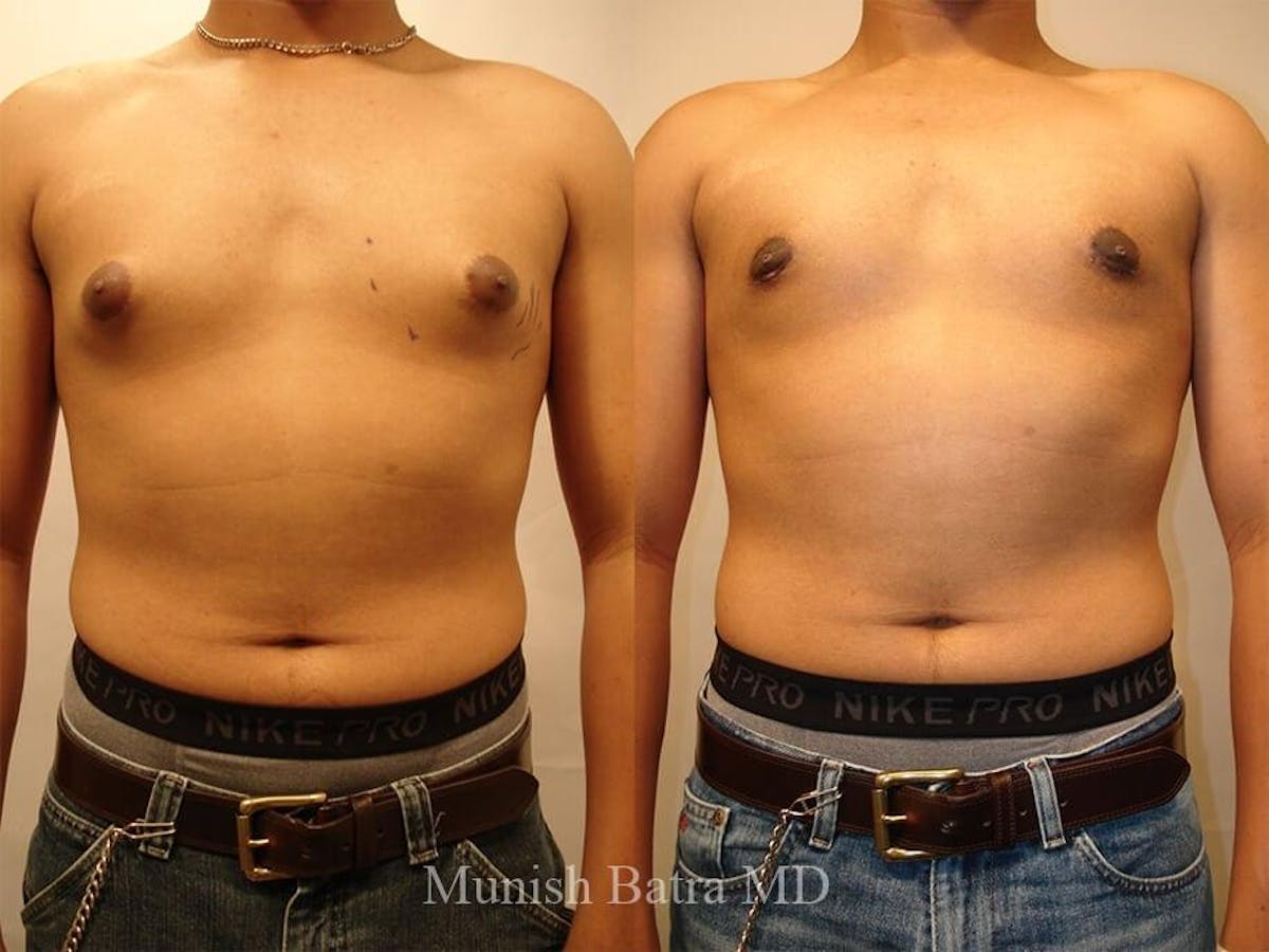 Gynecomastia Before & After Gallery - Patient 218280 - Image 1