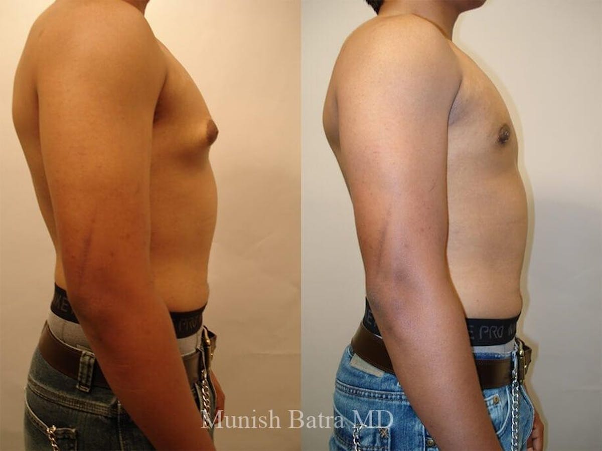Gynecomastia Before & After Gallery - Patient 218280 - Image 2