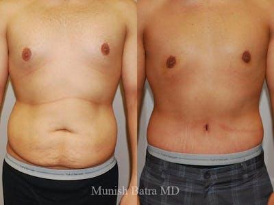 Gynecomastia Before & After Gallery - Patient 231914 - Image 1