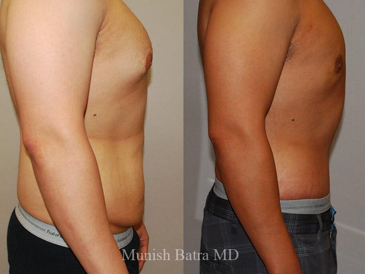 Gynecomastia Before & After Gallery - Patient 231914 - Image 2