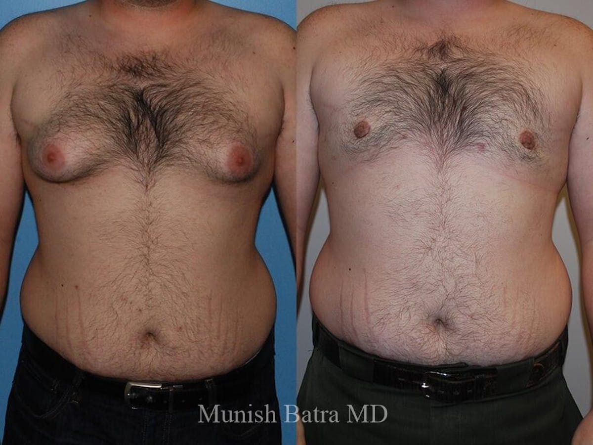 Gynecomastia Before & After Gallery - Patient 248012 - Image 1
