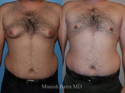 Gynecomastia Before & After Gallery - Patient 248012 - Image 1