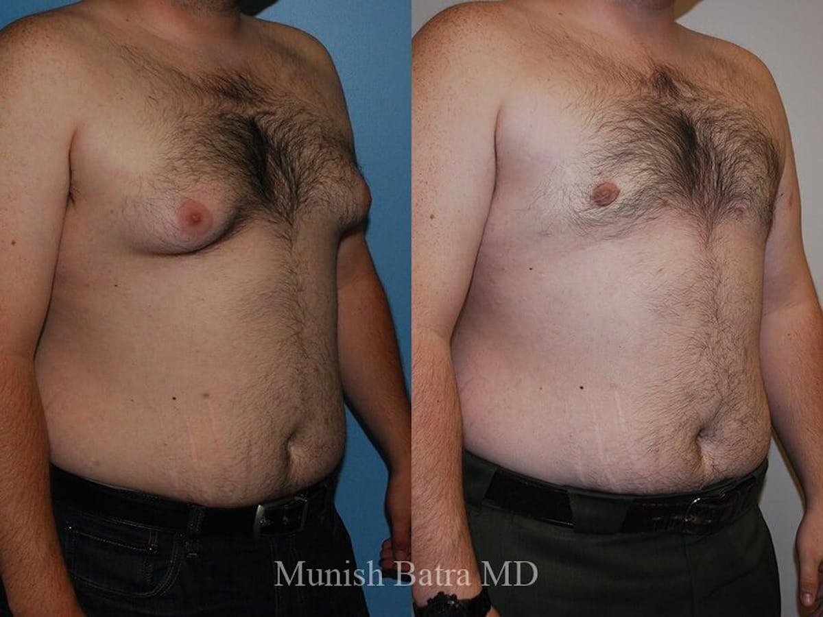 Gynecomastia Before & After Gallery - Patient 248012 - Image 2