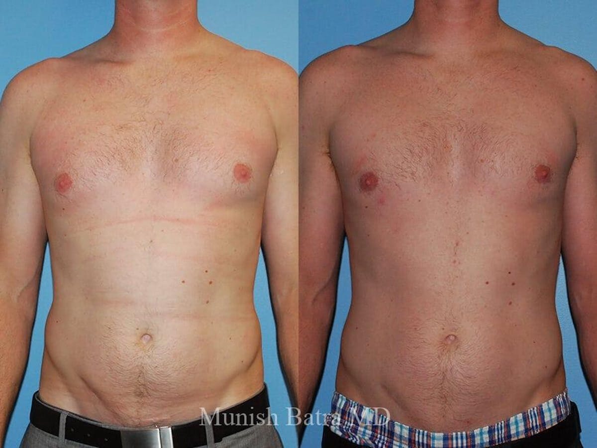Gynecomastia Before & After Gallery - Patient 937302 - Image 1
