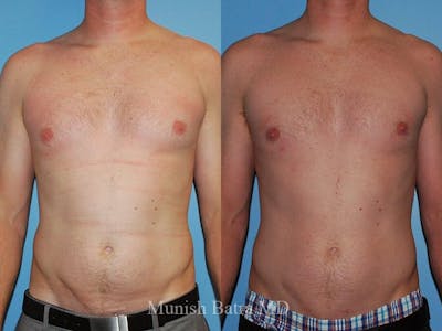 Gynecomastia Before & After Gallery - Patient 937302 - Image 1