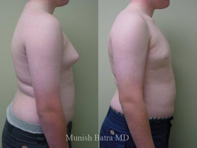 Gynecomastia Before & After Gallery - Patient 339842 - Image 1