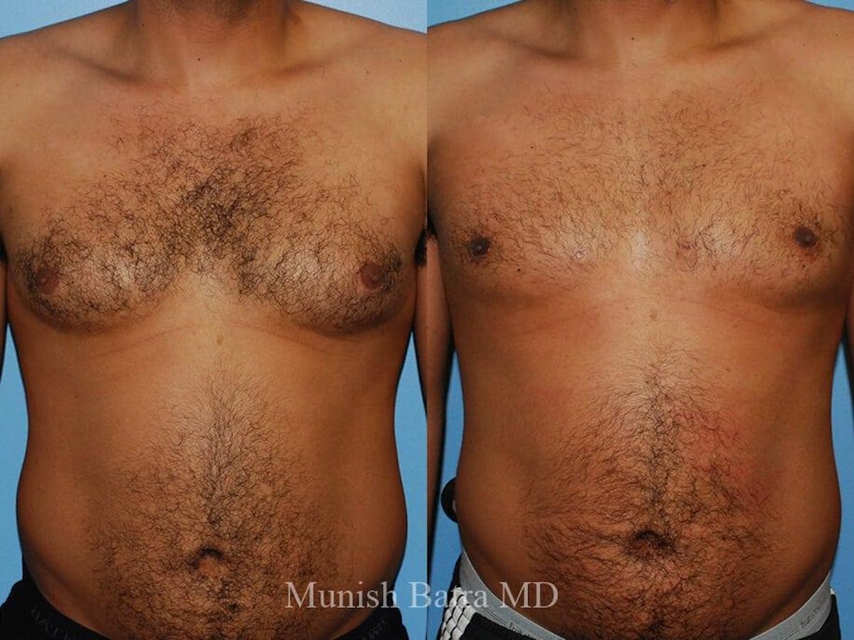 Gynecomastia Before & After Gallery - Patient 570717 - Image 1