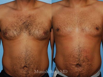 Gynecomastia Before & After Gallery - Patient 570717 - Image 1
