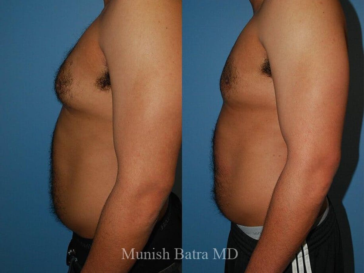 Gynecomastia Before & After Gallery - Patient 570717 - Image 2